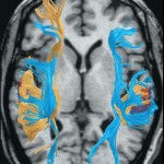 Skany mózgu pokazują, że dyslektycy czytają lepiej dzięki alternatywnym strategiom